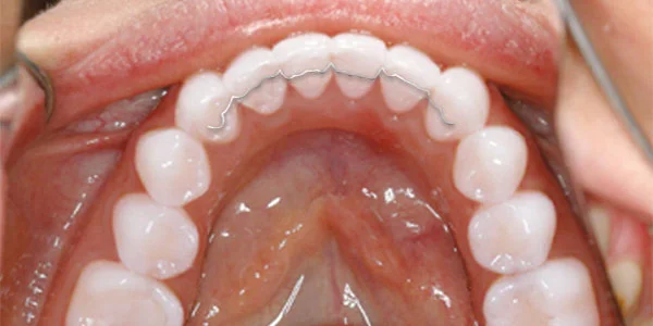 Digitaler Retainer